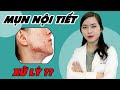 Nhận biết dấu hiệu của MỤN NỘI TIẾT? | Bạn có đang bị MỤN NỘI TIẾT? | BS. Nguyễn Ngọc