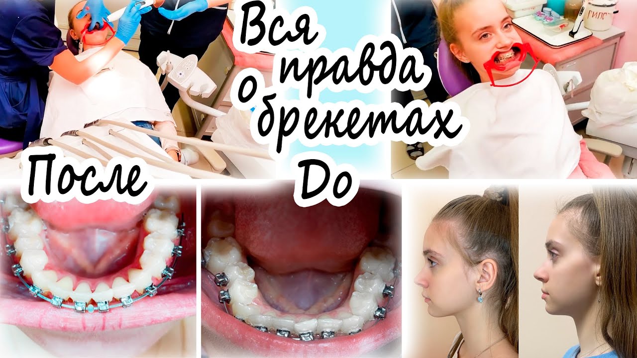 До После 😨 ДОВОЛЬНА ли Я РЕЗУЛЬТАТОМ 👉 ВСЯ ПРАВДА о БРЕКЕТАХ - YouTube