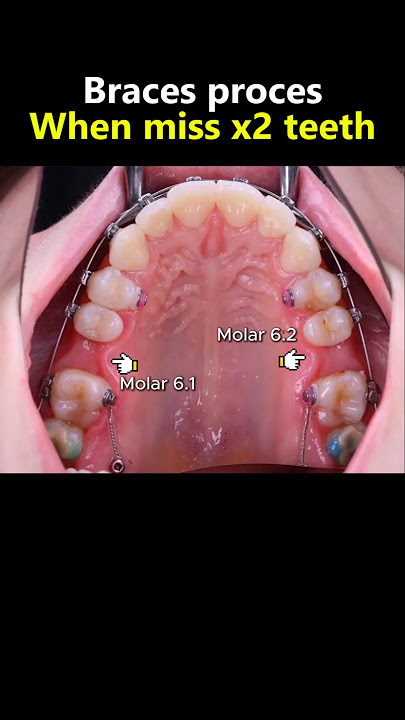 Miss x2 molar teeth and braces #dentist #orthodontist #teeth #braces