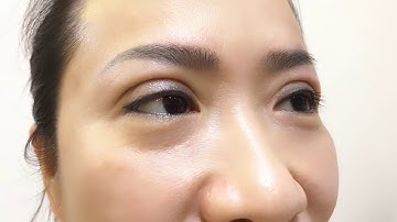 Ngạc Nhiên Với Nếp Mí Vừa Cắt Xong Tại Dr.Hải Lê.