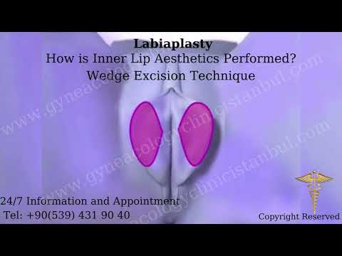 What is Type 2 Labiaplasty? How Is Wedge Labiaplasty Performed? Barbie Vagina Aesthetics