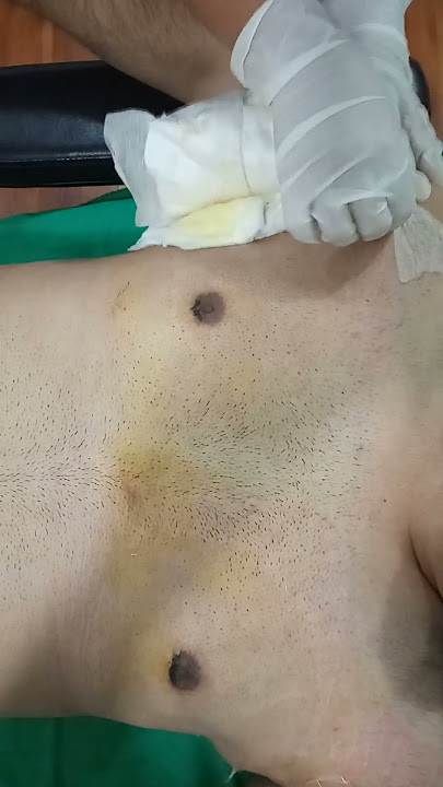 Gynecomastia Post-Op Result after 3 days of dressing removal