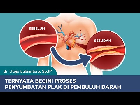 Penyakit Aterosklerosis - Gejala, Penyebab, Pengobatan - Bisabo Channel