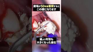 【歯石成敗】⚠️歯磨きをしないとこうなります🦷#歯石除去 #歯医者 #ザホワイトデンタルクリニック