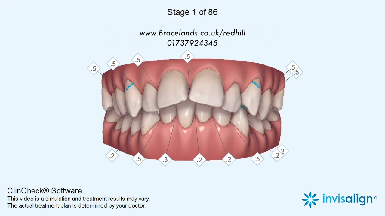 Invisalign Animation - Redhill Orthodontic Practice