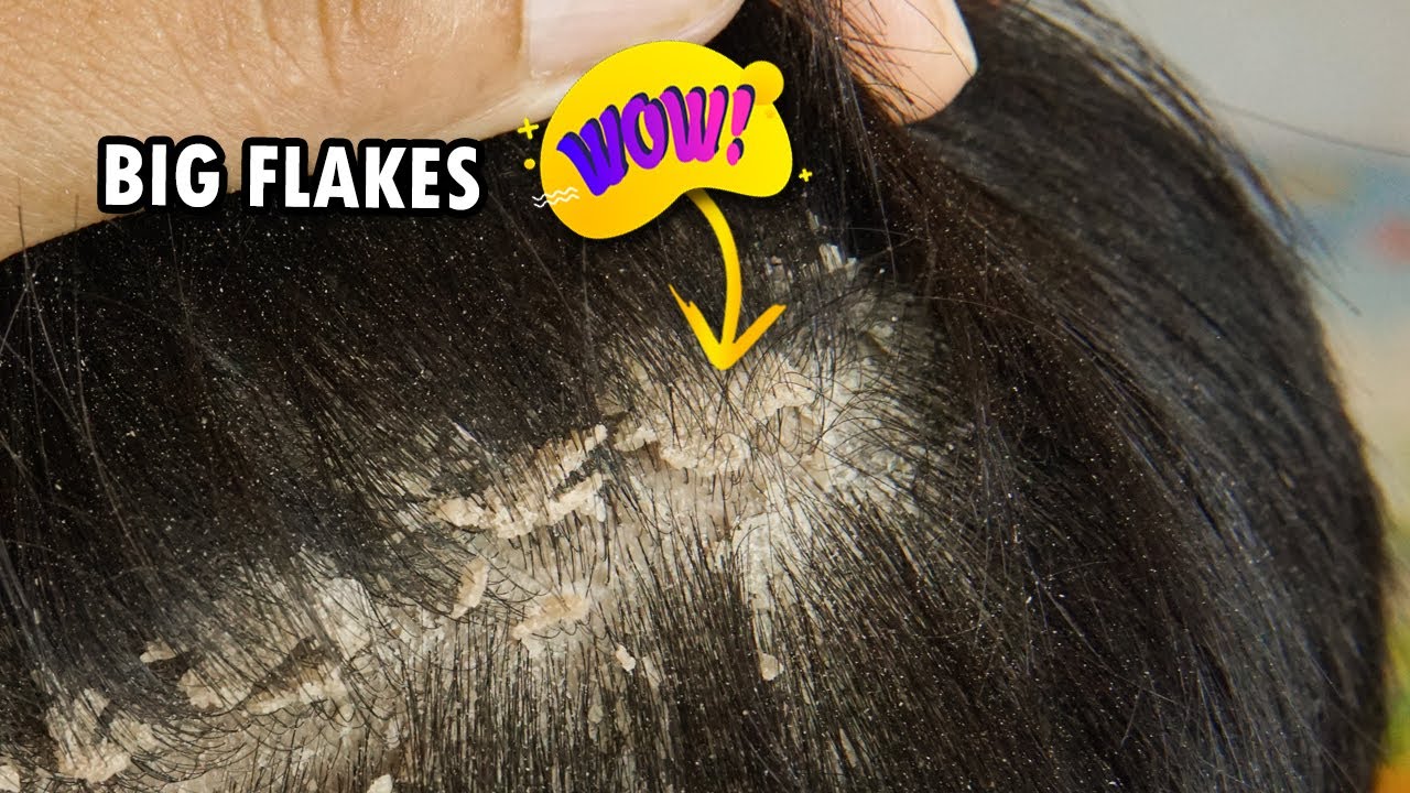 Satisfying Removal Of Dandruff Big Flakes!!! Dandruff Scratching 315
