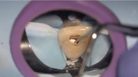 How to: single visit upper central RCT and MTA placement with composite restoration