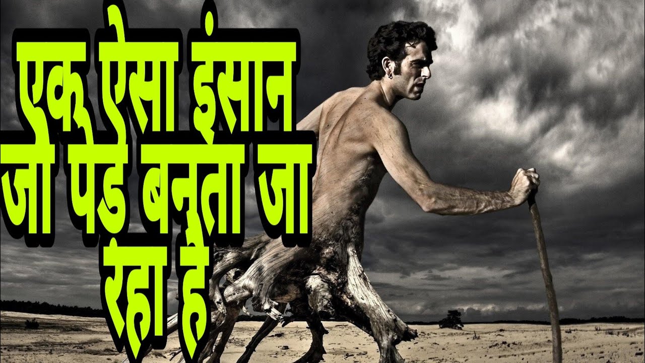 Half man half tree | एक ऐसा इंसान जो पेड़ बनता जा रहा है |my shocking story tree man | Wonderful ...