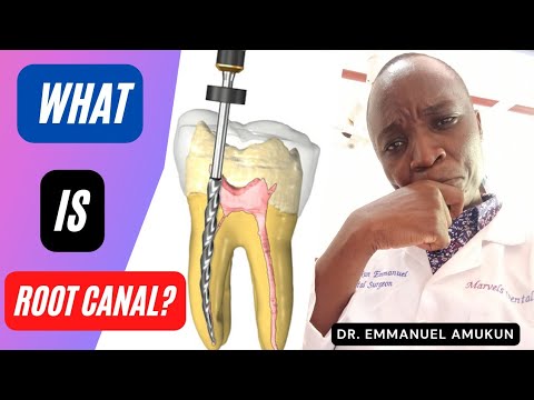 Video: Wakati wa matibabu ya endodontic mifereji ya pulpal humwagilia?