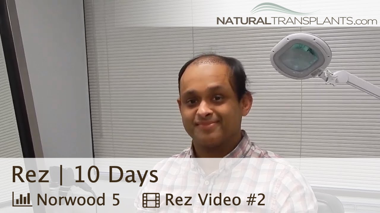 fue hair transplant month by month Hair Transplant Follow Up 10 Days Post Hair Transplant (Rez)