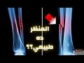 كسر عظمة الشظية كسور عظمة الشظية لماذا لا يتم تثبيت عظمة الشظية الكسر المهمل في كسور العظام