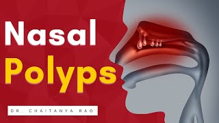 A to Z about Nasal Polyps | Sinus Expert talks by Sinus Doctor 34,029 views 1 year ago 12 minutes, 37 seconds