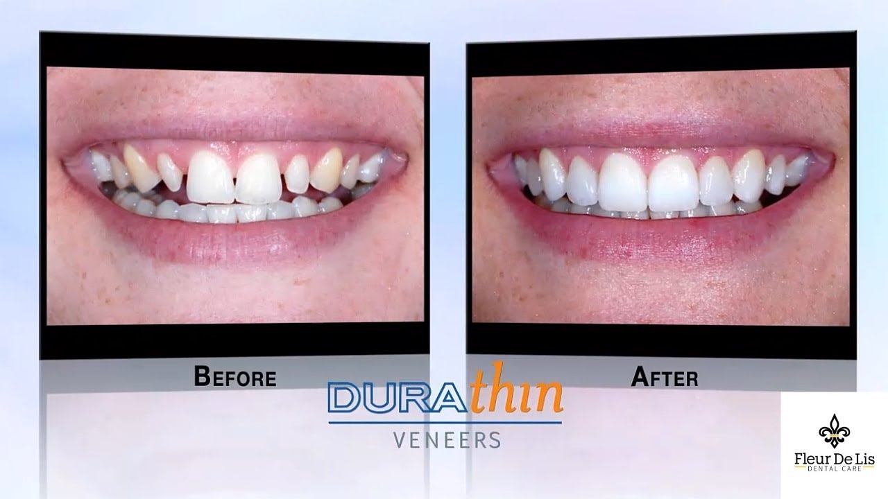 Durathin Veneers Review From Fleur de Lis Dental Care Patients YouTube