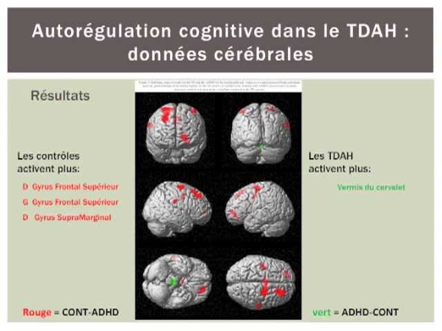 TDAH et le cerveau – Cerebrostim