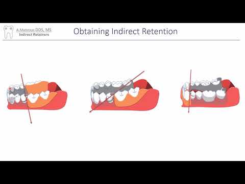 Parts Of Direct Retainer