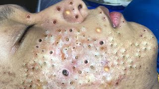 Relax Every Day With Treatment Satisfying blackhead relaxing acne, pimple, cyst by FISHING VIDEO 235 views 1 year ago 5 minutes, 21 seconds