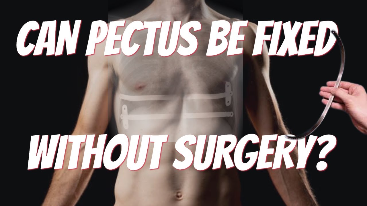 CAN PECTUS EXCAVATUM BE FIXED WITHOUT SURGERY? YouTube