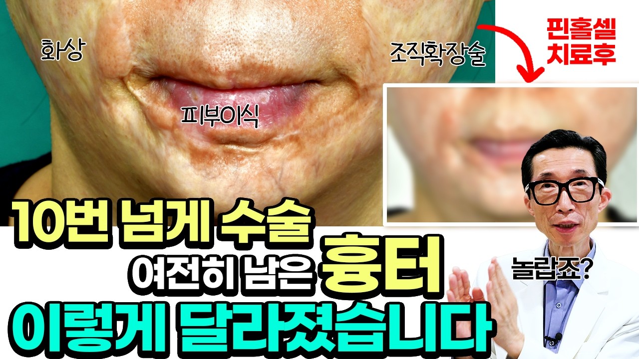 화상 흉터를 없애기 위해 10번을 넘게 수술했지만 그래도 남은 흉터를 핀홀셀로 해결해드렸습니다????[실제치료후기]