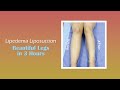 Before & After Lipedema Leg Transformation | Expert Dr. Thomas Su