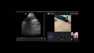 Teach the eFAST exam remotely 3/4 - Left Upper Quadrant