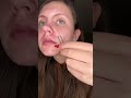 Pimple patches removal #pimplepatchremoval #satisfying #asmr #pimples #sick #acne #skincare #makeup