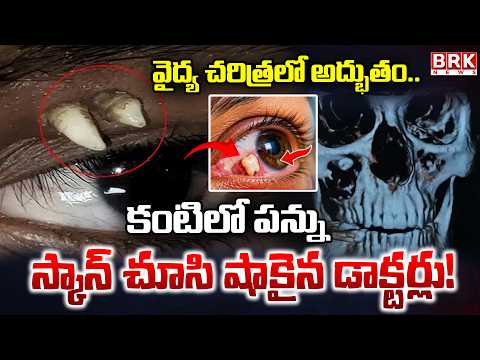 Medical Miracle! Doctors Shocked After Scan Reveals a Tooth Inside the Eye | BRK News - TV9