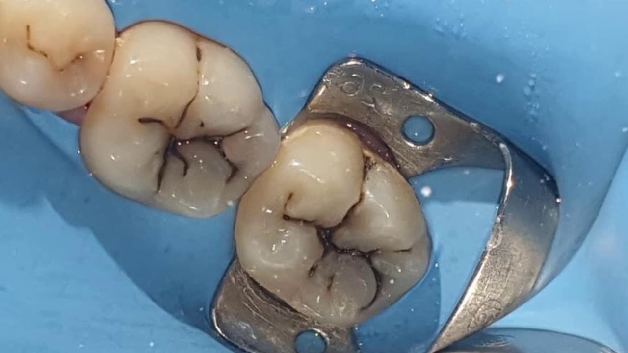 Direct Composite Restoration ( Stamp Technique ) YouTube