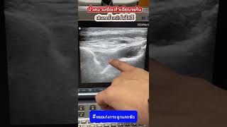 ปวดบวมข้อเท้าเฉียบพลัน เดินลงน้ำหนักไม่ได้ #หมอเก่งกระดูกและข้อ #ปวดข้อเท้า #ข้อเท้าอักเสบ #เก๊าท์