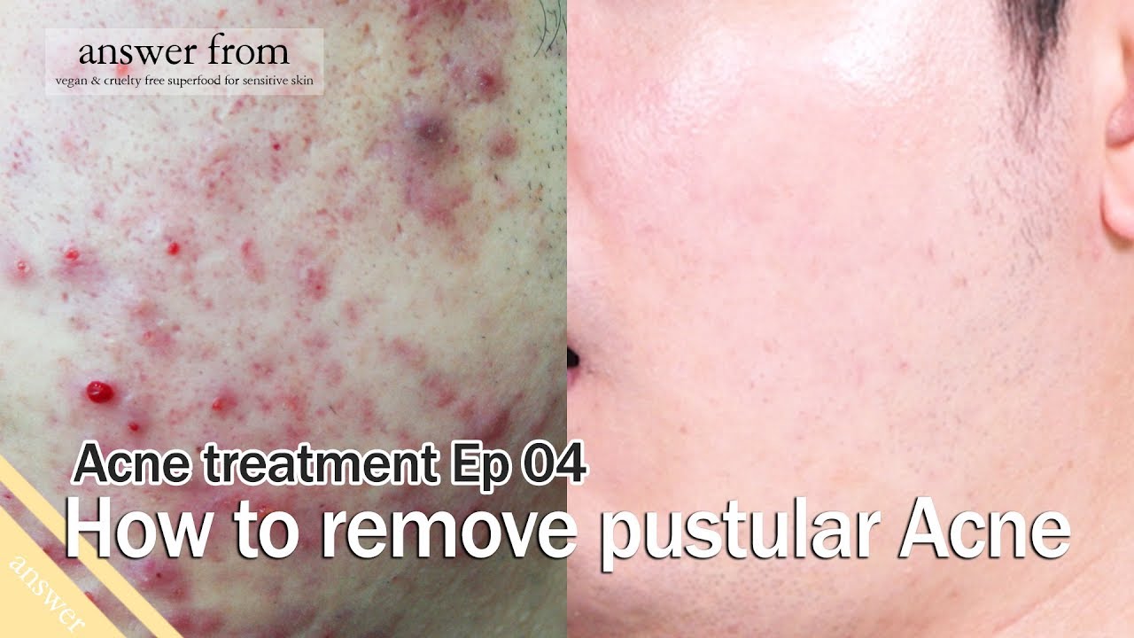 Acne treatment Ep 04 : How to remove Pustules Acne