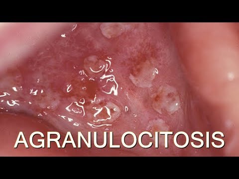 AGRANULOCITOSIS : MEDICINA HUMANA | MediCiencia