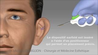 Earfold : une technique non chirurgicale pour les oreilles décollées - Dr Corniglion