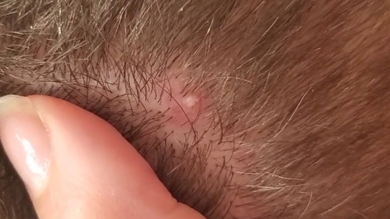 The Most Satisfying Ingrown Hair Pulling Juicy Hair Part 53 YouTube