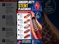 #angioplasty stent procedure #cardiovascularhealth #learnwithme #savelife #studypurpose 👍👍