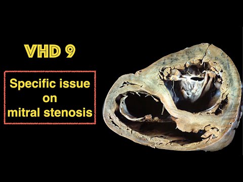 VHD 9 Mitral stenosis