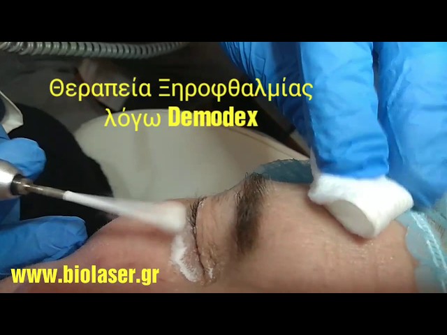 Demodex, Βλεφαρίτιδα- Θεραπεία χωρίς φάρμακα