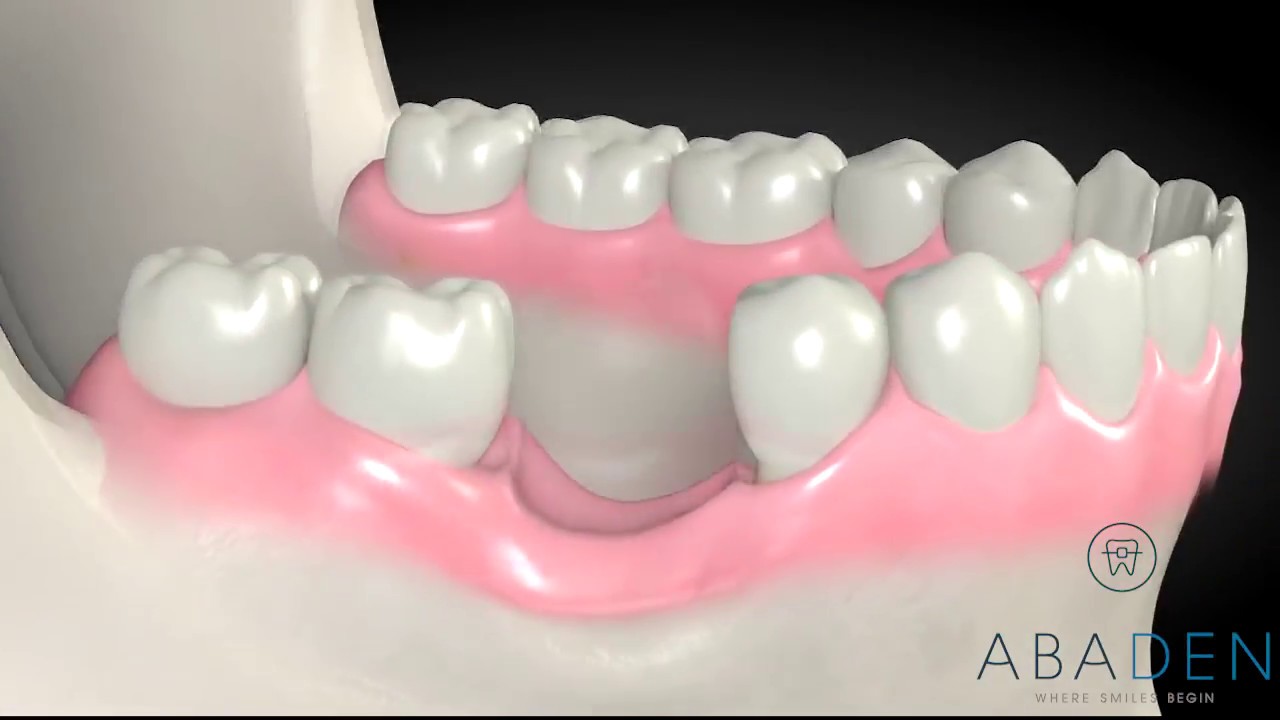 Injerto de hueso dental Colocación de Implante dental con injerto de