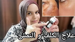 تخلصي نهائيا من الكلف بعد الولادة | وصفة للكلف | مجربة و فعالة 100%