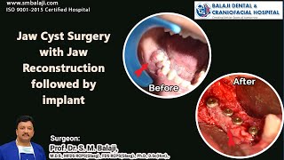 Jaw Cyst Surgery with Jaw Reconstruction followed by implant