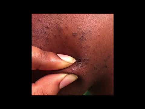 Extreme Case Of Ingrown Hair Youtube