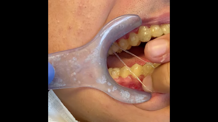 ELASTICI INTERARCATA CON APPARECCHIO INVISALIGN: come si mettono?
