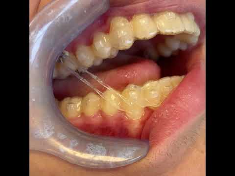 Video: È possibile correggere l'overbite con invisalign?