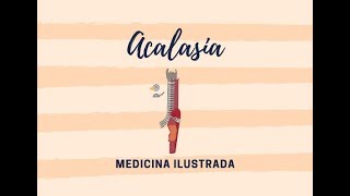 Acalasia