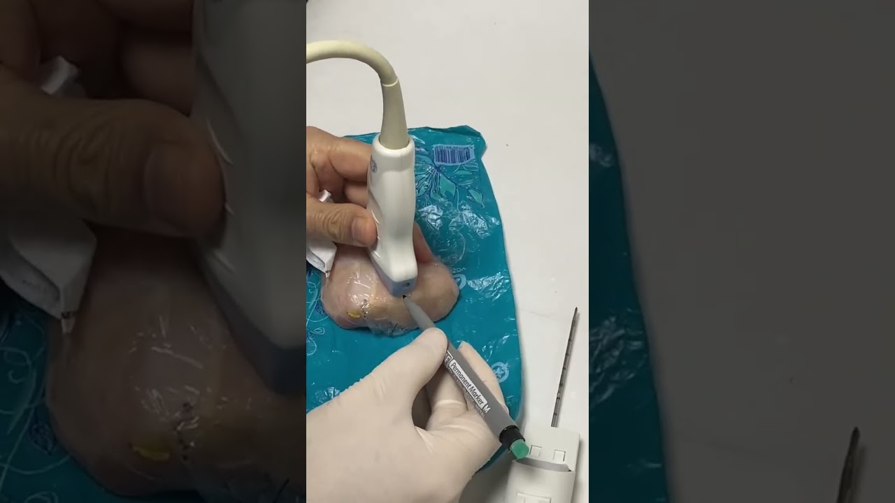 طريقة اخذ خزعة بتوجيه الايكو