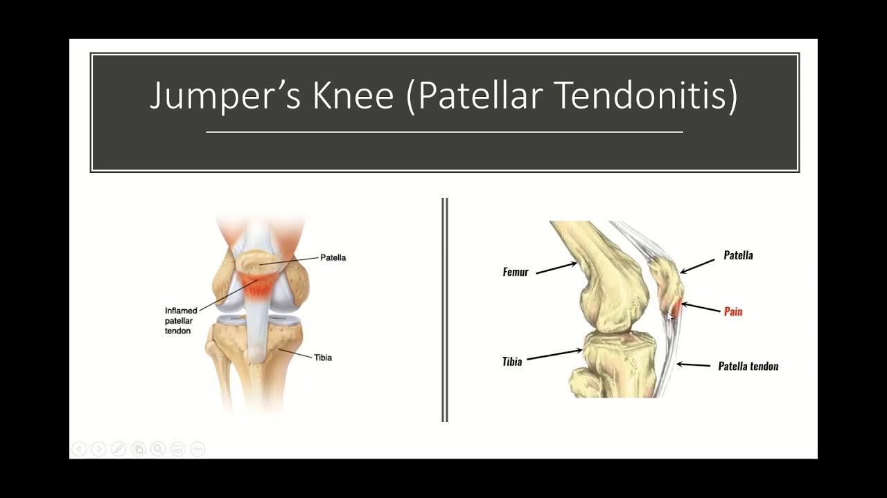 Jumper's Knee and Osgood Schlatter's Disease in the Knee YouTube