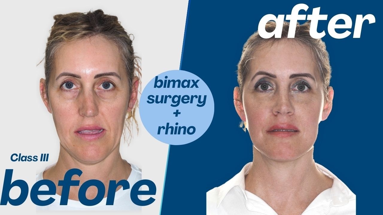 Bimaxillary Surgery Case #182-Pilar: Class III, Maxillary retrusion, Mandibular asimmetry, Crossbite