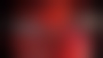 Laparoscopic transperitoneal left heminephrectomy for upper non-functioning moiety of left kidney