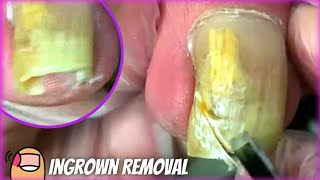 Cutting this Long Ingrown Toenail by Podiatrist | Treatment & How to remove | get rid of it PEDICURE