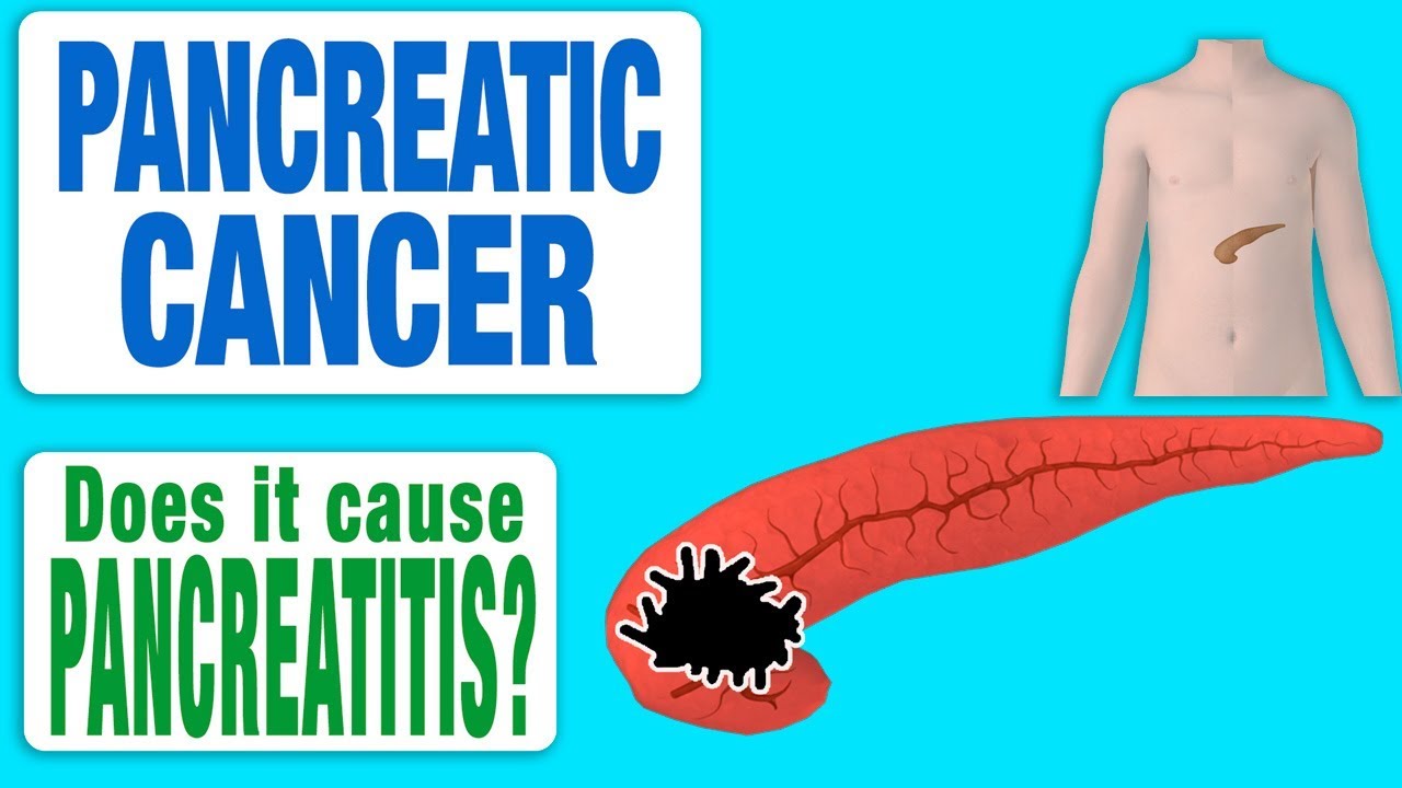 Pancreatic Cancer Does it cause Pancreatitis? YouTube