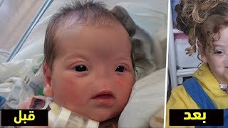 هذه الطفلة ولدت دون أنف، كانت صدمة للعائلة.. ولكن بعد 5 سنوات تغير كل شيء !!