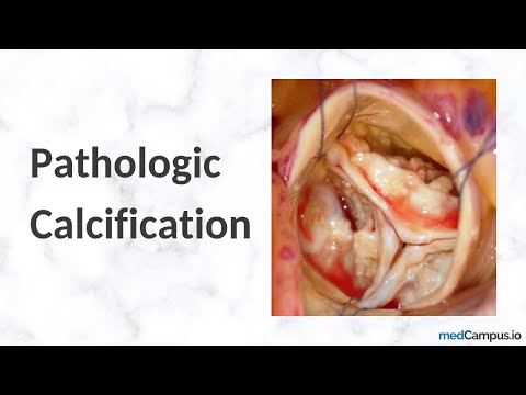 Vidéo: Calcification: Types, Causes Et Diagnostic